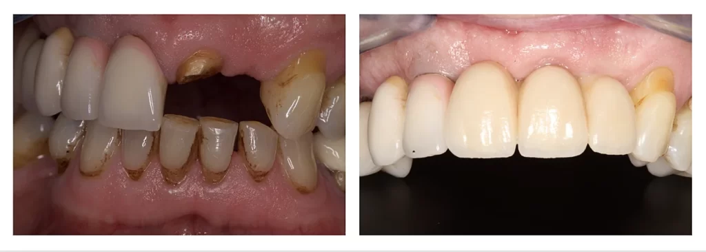 tooth placement near me